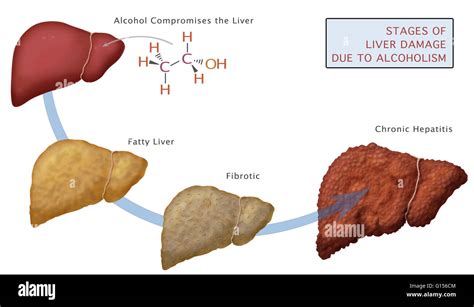 Stages of liver damage due to alcoholism. First alcohol compromises the ...