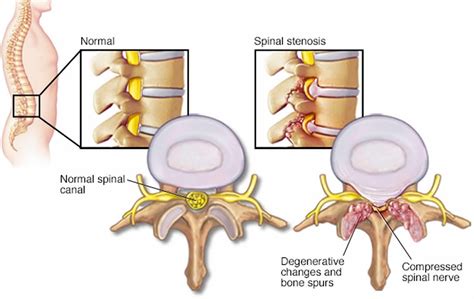 Spinal stenosis causes, symptoms, diagnosis, treatment and exercises