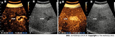 Hemangioma. A: Contrast-enhanced ultrasound examination in the arterial ...