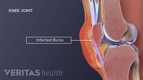 Knee (Prepatellar) Bursitis | Arthritis-health