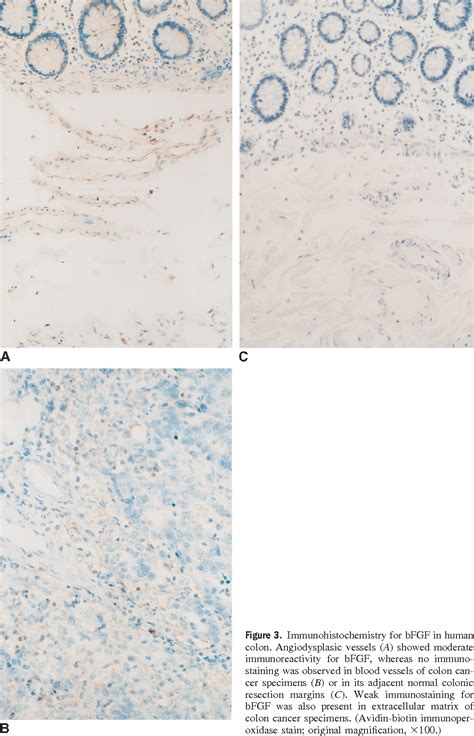 Angiodysplasia of colon | Semantic Scholar