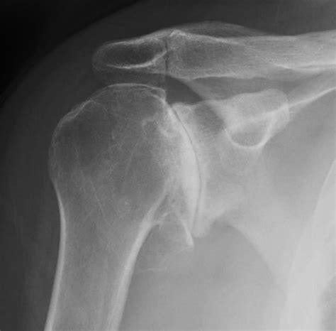 Shoulder Arthritis (Glenohumeral Arthritis) — Andrew Dold, MD ...