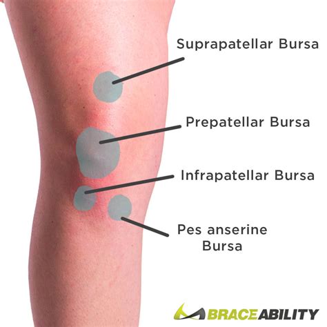 Lateral Bursitis Knee