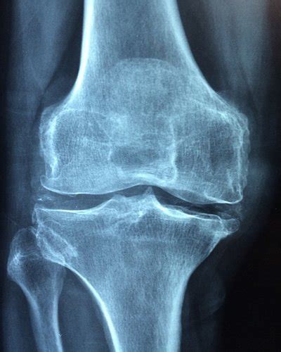 What are the Signs and Symptoms of Osteoarthritis? - Health Advisor