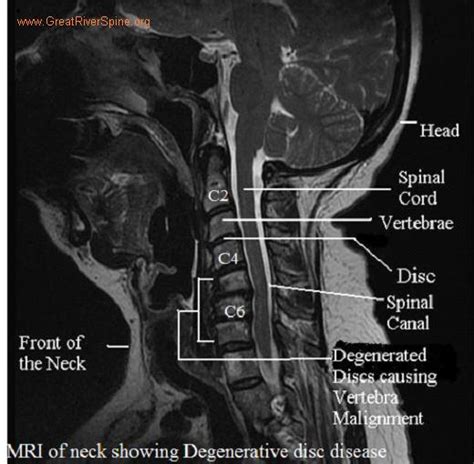 Cervical Disc Degeneration. Causes, symptoms, treatment Cervical Disc ...