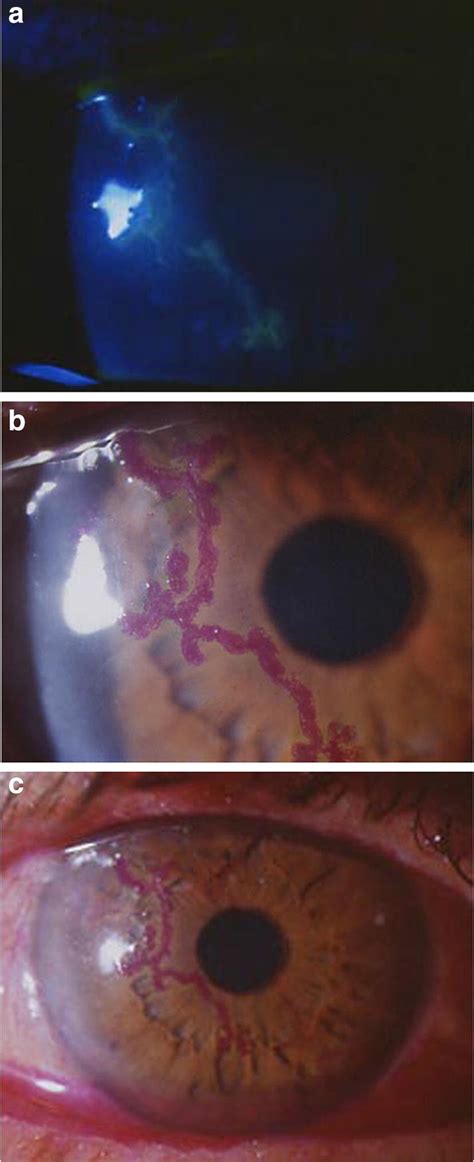 a Dendritic ulcer (Epithelial keratitis) highlighted by staining with ...