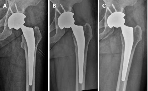 Radiographs of Case 2. A: Radiograph taken immediately after total hip ...