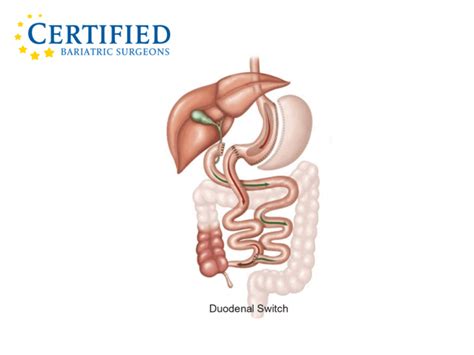 Duodenal Switch Surgery | Certified Bariatric Surgeons