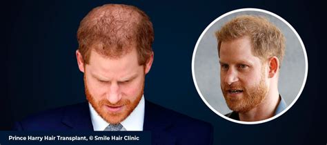 All About Prince Harry Hair Transplant - Smile Hair Clinic