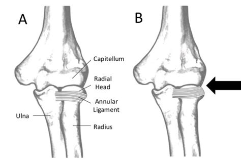 Radial Head Subluxation – Core EM