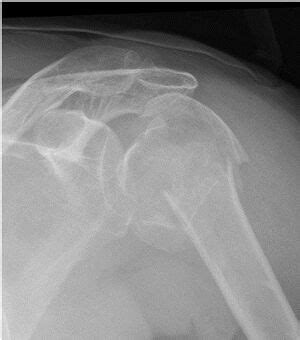 Proximal Humerus Fractures - Physiopedia