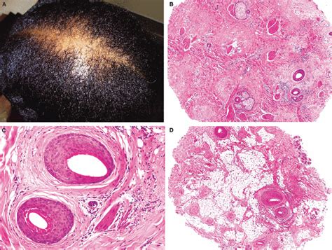 Scarring Alopecia Histology