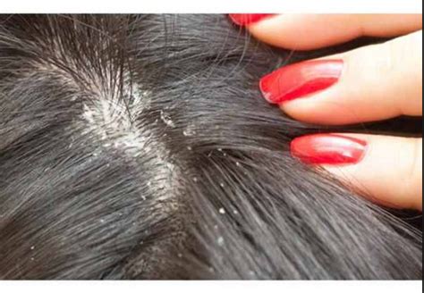 Dry Scalp: Causes, Symptoms and Treatment