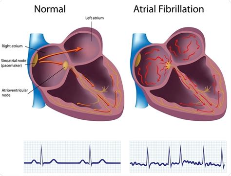 Atrial Fibrillation (AF)