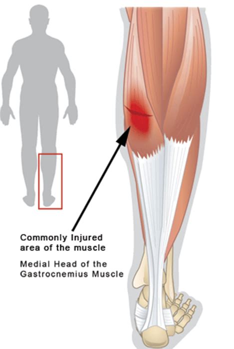 Calf Muscle Strain :: Chappell Physical Therapy, LLC