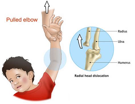 Dislocated Elbow - Causes, Signs, Symptoms, Recovery & Treatment