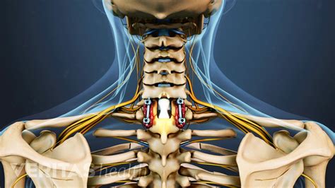 A Step-by-Step Guide to Cervical Laminectomy Surgery