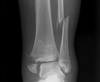 Fibula Fracture - Types, Recovery, Causes, Symptoms, Distal, Proximal