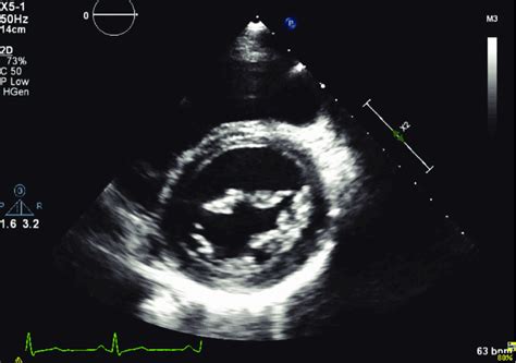 At the mitral valve short-axis level myxomatous changes of the mitral ...