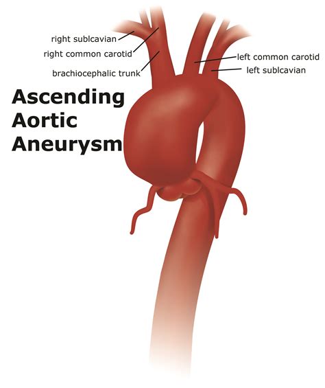 Thoracic aortic aneurysm - UF Health