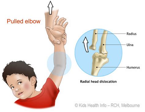 Dislocated Elbow