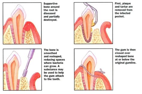 Gums Graft Surgery, Laser Gum Flap Surgery, Gingivectomy Delhi