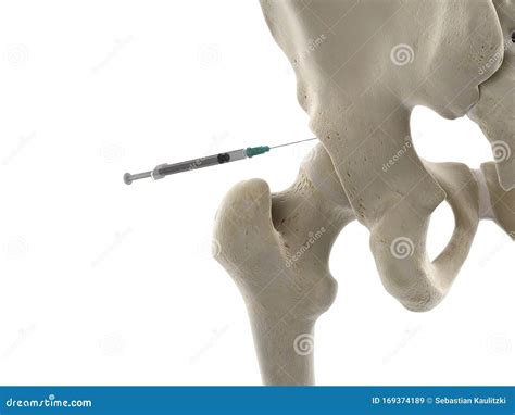 A hip joint injection stock illustration. Illustration of femur - 169374189