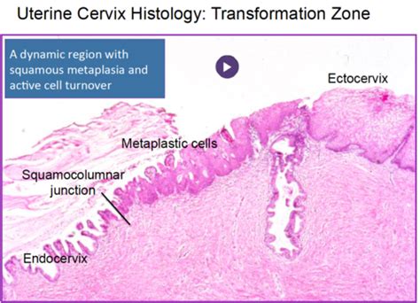 Cervical/Vaginal - Squamous lesions Flashcards | Quizlet