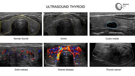 Thyroid Ultrasound Cancer