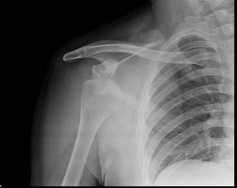 Anterior shoulder dislocation | Image | Radiopaedia.org