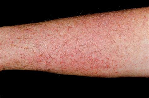 Skin Rash On Arms