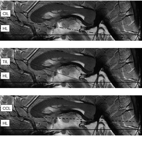 (PDF) Anterior Commissure - Posterior Commissure Revisited