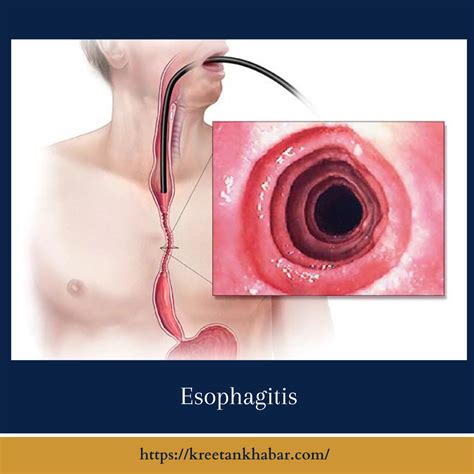 Esophagitis: Causes, Symptoms, Diagnosis, and Treatment - Kreetan Khabar