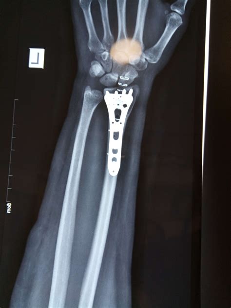 Orthopedic Trauma (Fracture) Treatment | Ahmedabad | Dr. Rachit Sheth