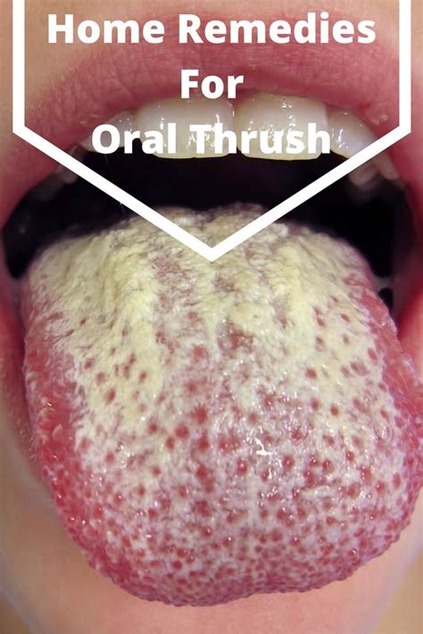 Home Remedies To Get Rid Of Oral Thrush