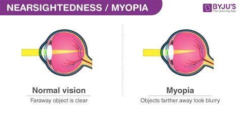 Myopia Causes, Symptoms, Formula And Nearsightedness