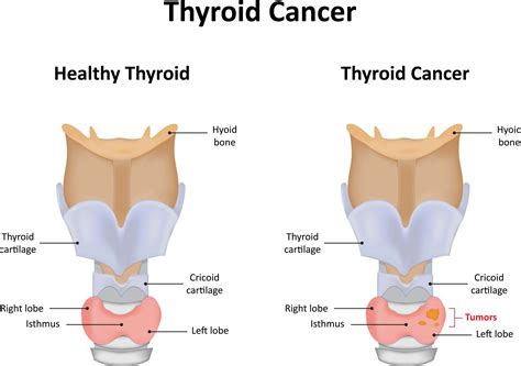 Thyroid Ultrasound Cancer