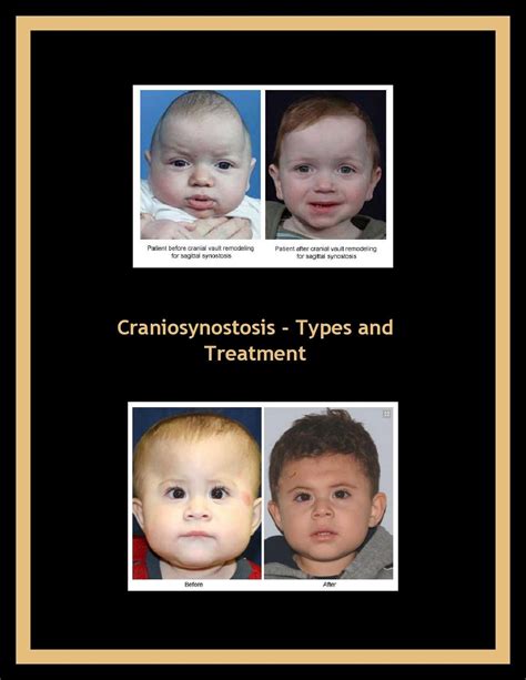 Craniosynostosis - Types and Treatment by Dr Sean Boutros - Issuu