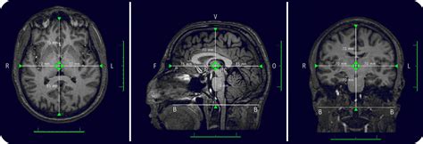 Atlas | JHP MRI Brain Atlas