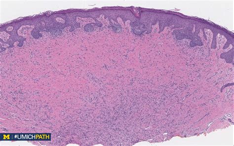 Dermatofibroma Histology