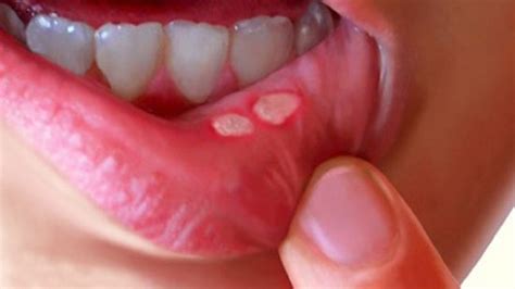 Mouth Sores: Causes, Symptoms, Diagnosis, Treatment and Prevention ...