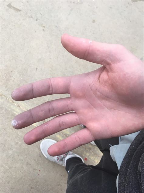 My friend’s hands turn purple when it gets cold out : r/mildlyinteresting