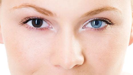 Heterochromia - Different Colored Eyes Causes and Types