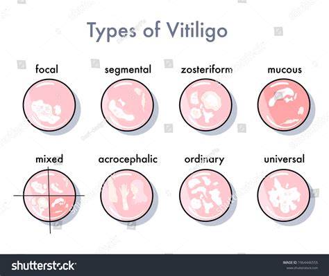 479 Vitiligo Types Images, Stock Photos, 3D objects, & Vectors ...