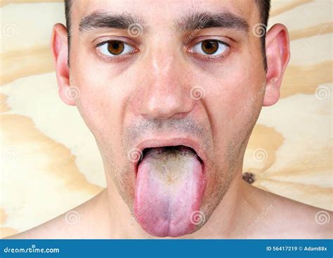 Infection Tongue Stock Photo - Image: 56417219