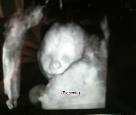 3D Ultrasound: 3d Ultrasound Gender Reveal