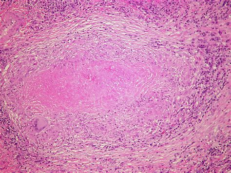 Tuberculosis Lungs Histology