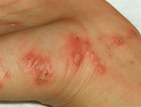 👉 Scabies Rash - Pictures, Symptoms, Treatment, Causes (February 2022)