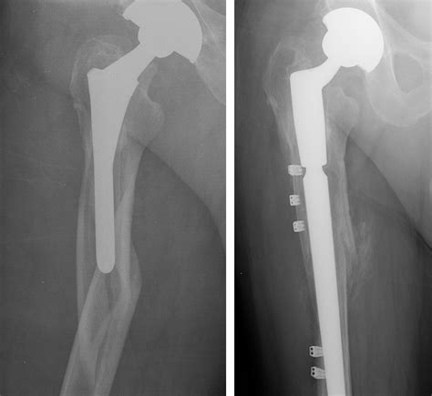 Fracture After Total Hip Replacement - Orthopedic & Sports Medicine