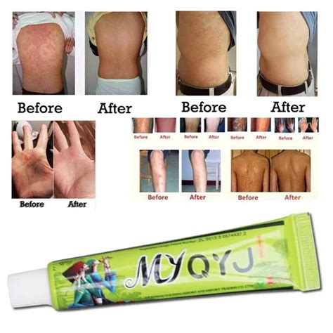 15g/box Hot sell Skin Psoriasis Cream Dermatitis Eczematoid Eczema ...